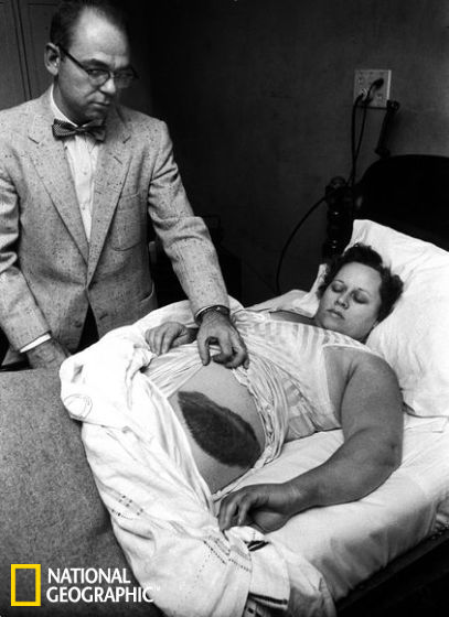 1954年，医生穆迪·雅各布（Moody Jacobs）展示他的病人——安·霍吉斯女士身上的一个大伤口，这是被陨石擦伤导致的 