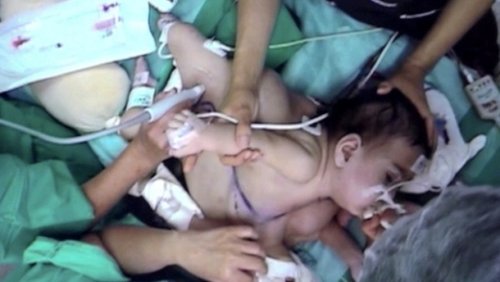 本月13日，智利连体女婴玛莉亚帕斯和玛莉亚荷塞做手术前的情景