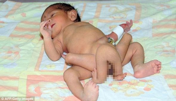 .巴基斯坦医生正在努力拯救一名新生儿的性命，这名上周出生的男婴长着6条腿，这是因为他患有罕见的遗传病